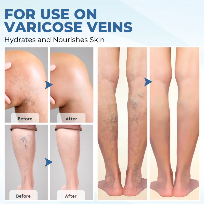 TheraVein Varicose Herbal Spray