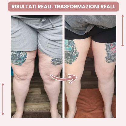 Leggings 3D  : dì addio al dolore e al gonfiore del lipedema in modo naturale