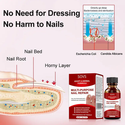 SOVS Toenail Fungus Treatment Extra Strength ,Antifungal Solution ,Triple Action Formula for Damaged Nails, Multi-Purpose Nail Repair,1 Fl Oz Manicure Therapy