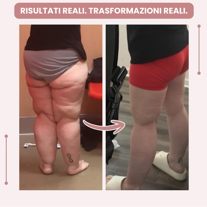 Leggings 3D  : dì addio al dolore e al gonfiore del lipedema in modo naturale