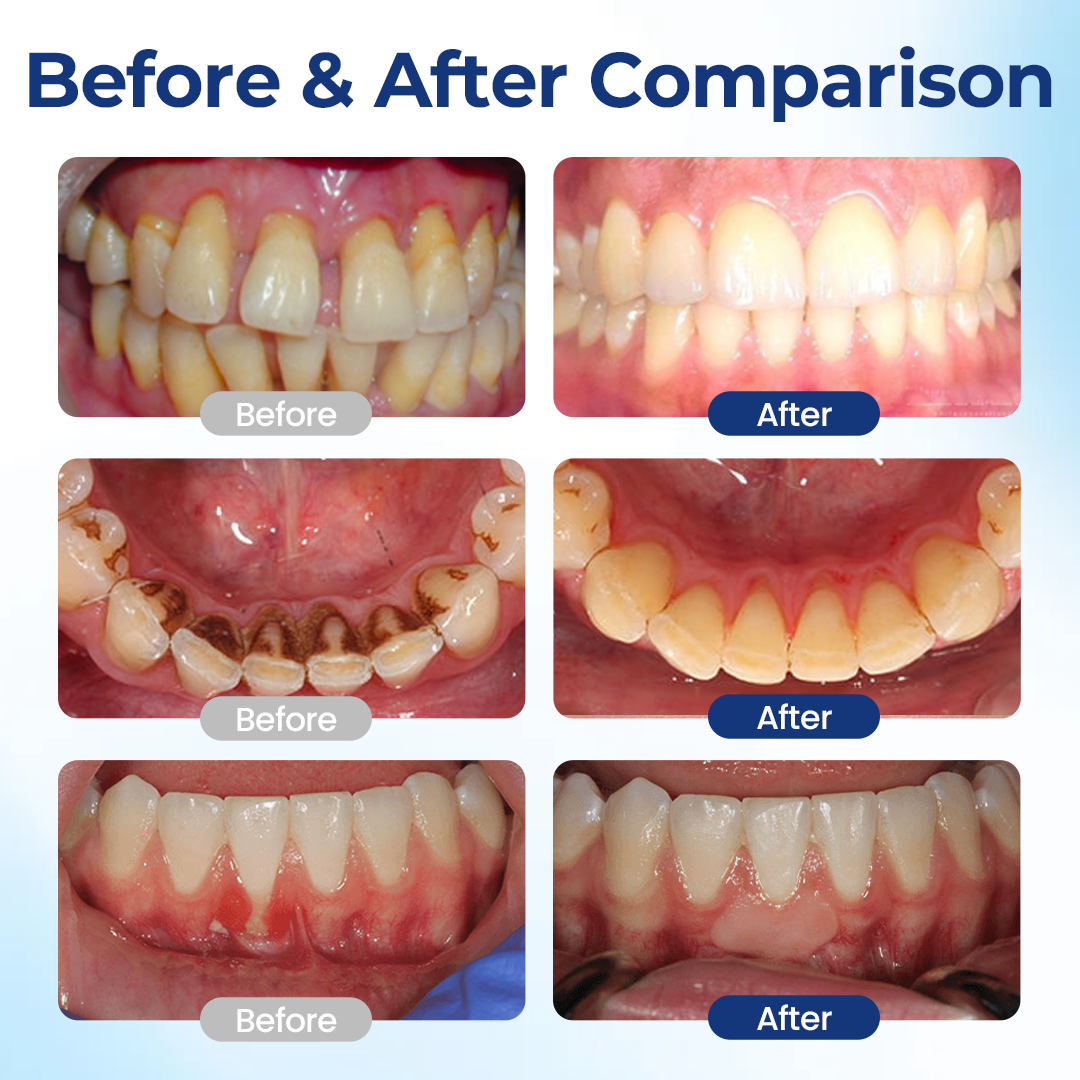 Smileasego™ Gum Restore Solution,Gum Regrowth Helps Dry Mouth and Bad Breath