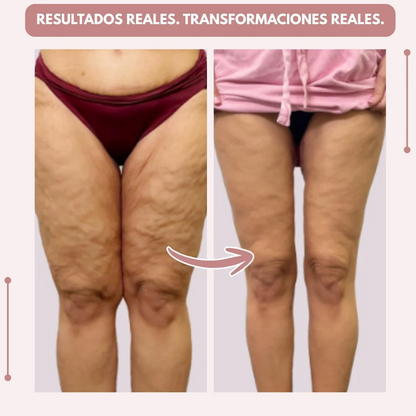 Leggings 3D  : dì addio al dolore e al gonfiore del lipedema in modo naturale