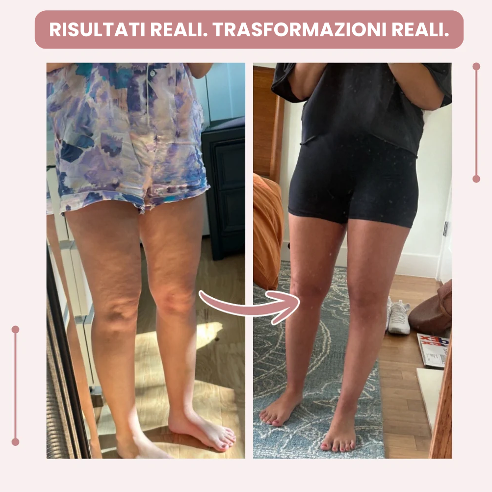 Leggings 3D  : dì addio al dolore e al gonfiore del lipedema in modo naturale