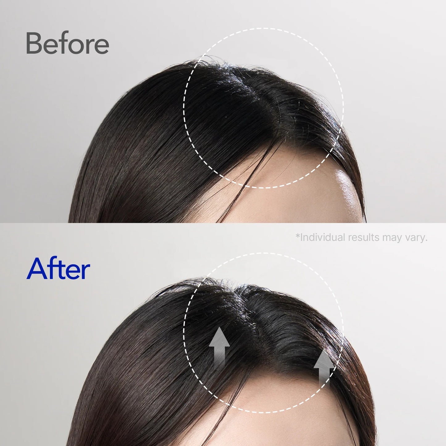 [Buy 1 Get 1] ViveLeb Spioxyl™ Scalp Serum 400 – 220K Micro-Spicules for Thicker, Fuller Hair | Korea’s Best-Selling Dermatologist-Recommended K-Beauty Volume Booster Serum (0.5 fl oz)